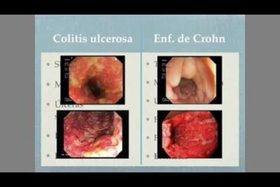 Imágenes endoscópicas comparativas que muestran mucosa ulcerada de colitis ulcerosa y lesiones segmentarias de enfermedad de Crohn XKMumZEqU0Y