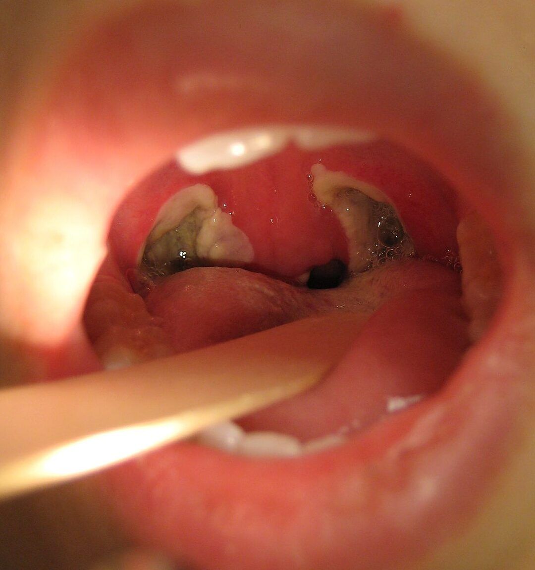 Amígdalas inflamadas con placas blancas, imagen para anginas naturales fumar empeora los sintomas.