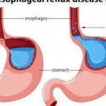 ¿Conoces los efectos de vomitar en exceso en tu cuerpo?