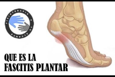 Ilustración de un pie con la fascia plantar resaltada y texto explicativo sobre fascitis plantar dAn PgHe7KQ