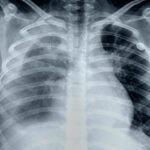 Derrame pleural en los pulmones: todo lo que necesitas saber