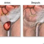 Descubre cómo tratar la hernia inguinal en hombres de forma efectiva