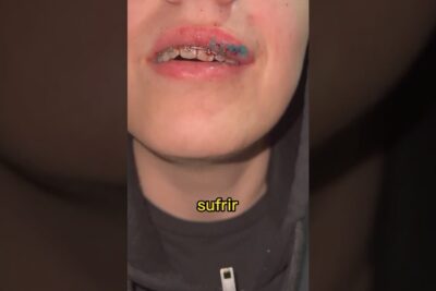 Primer plano de la boca con brackets y una mancha azul en el labio, descubre en profundidad que significa asmr y como afecta a tu cuerpo y mente
