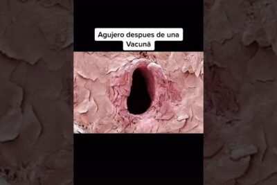 Imagen macro de un agujero en la piel con texto 'Agujero despues de una Vacuńa', descubre que comen las avispas y como influye en su comportamiento