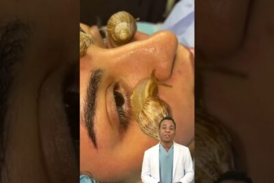 Primer plano de rostro con caracoles sobre la piel mostrando echas caracol.
