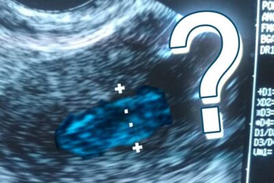 Ecografía transvaginal que muestra un endometrio grueso señalado con calipers y área resaltada