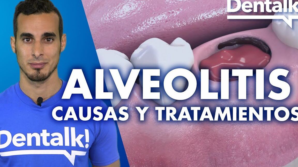Imagen de un profesional dental junto a una ilustración de cavidad bucal y alveolo afectado que explica fumar despues de la extraccion de la muela del juicio descubre las consecuencias