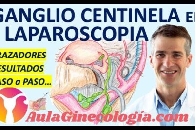 Diagrama anatómico y explicación sobre ganglio centinela 1 en laparoscopia acompañado de profesional médico sonriente