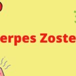 ¿Qué sucede si el herpes zóster no aparece? Explicación completa