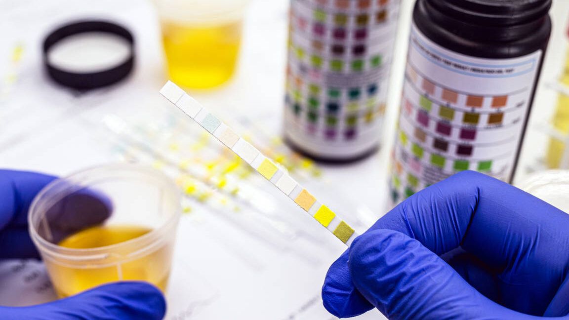 Tira reactiva de orina sostenida con guantes junto a vaso de muestra y cartas de color, ilustrando por que orinar mucho puede indicar un problema de salud