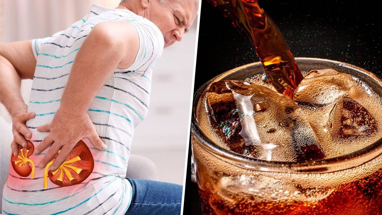 Persona con dolor lumbar e ilustración de riñones junto a un vaso de refresco que sugiere que consecuencias tiene orinar en exceso para tus rinones