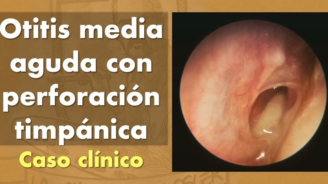 Imagen endoscópica que muestra otitis media aguda con perforación timpánica y secreción, ilustrando que consecuencias tiene que entre agua en un timpano perforado en casa.