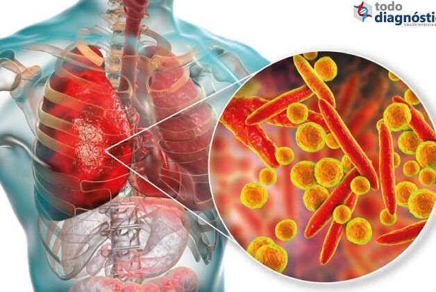 que es la meningitis y la encefalitis descubre su significado aqui 1