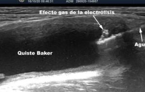 Ecografía que muestra un quiste de Baker poplíteo con señal de gas y aguja en procedimiento, que sucede si el quiste de baker se rompe descubre todo aqui.