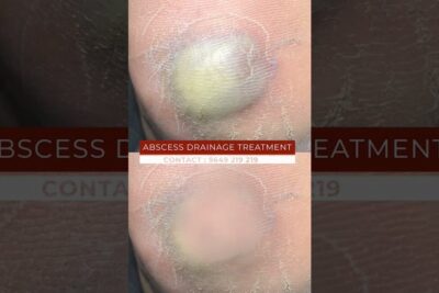 Primer plano de piel con tampon inflamado y zona amarillenta similar a un absceso