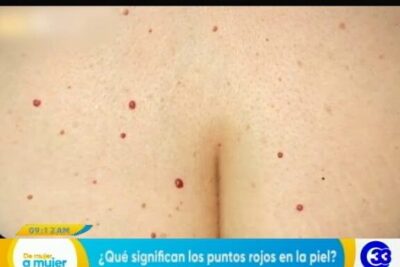 Primer plano del pecho con múltiples puntos rojos en la piel; todo lo que debes saber sobre el significado de 701.