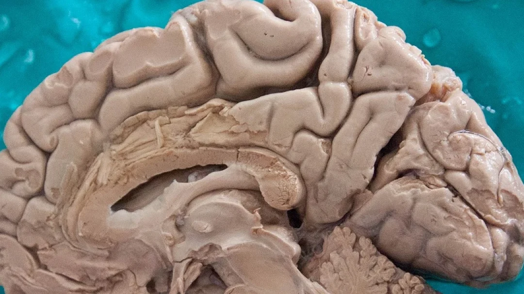 Sección sagital de un cerebro humano utilizada para explicar todo lo que necesitas saber sobre el derrame cerebral en el lado derecho del cerebro.